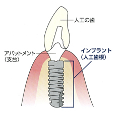 インプラント治療